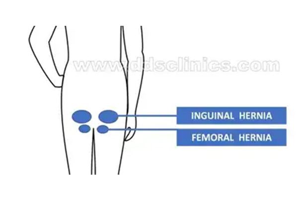 Groin Hernia